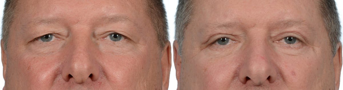 Blepharoplasty (Eyelid Surgery) Before & After Gallery - Patient 378899 - Image 1