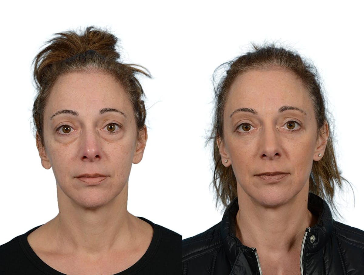 Blepharoplasty (Eyelid Surgery) Before & After Gallery - Patient 414769 - Image 1