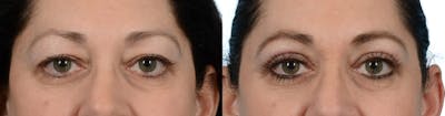 Blepharoplasty (Eyelid Surgery) Before & After Gallery - Patient 341647 - Image 1