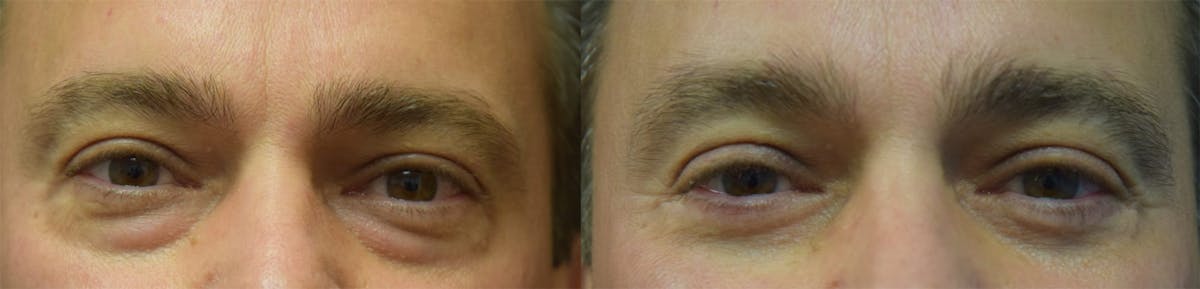 Blepharoplasty (Eyelid Surgery) Before & After Gallery - Patient 375645 - Image 1