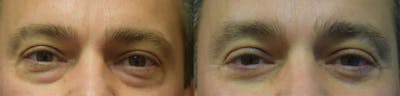 Blepharoplasty (Eyelid Surgery) Before & After Gallery - Patient 375645 - Image 1