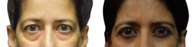 Blepharoplasty (Eyelid Surgery) Before & After Gallery - Patient 391518 - Image 1