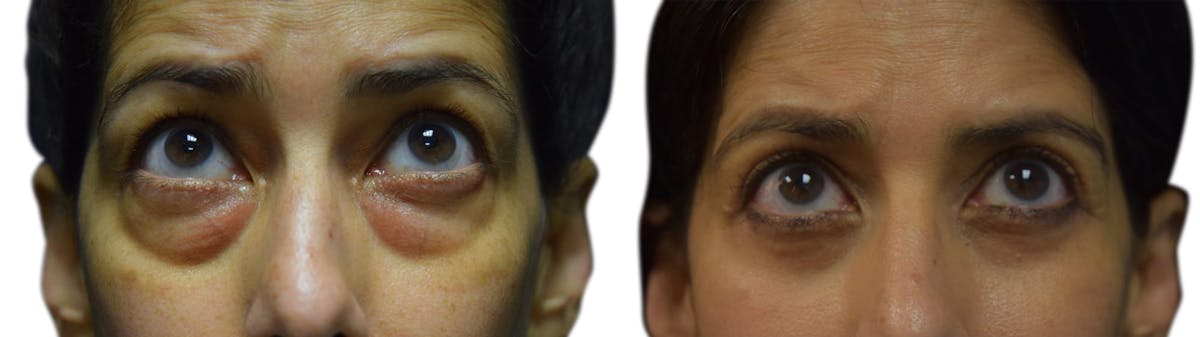 Blepharoplasty (Eyelid Surgery) Before & After Gallery - Patient 391518 - Image 2