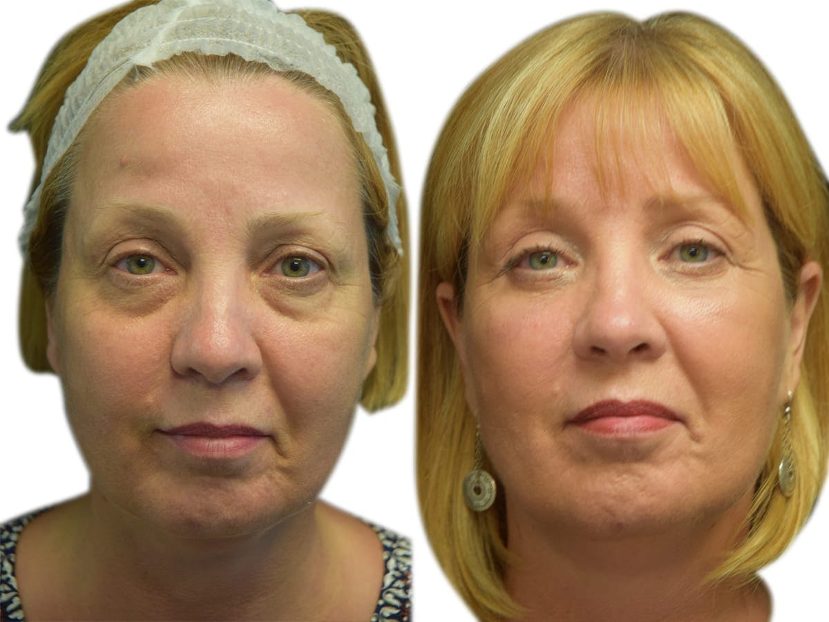 Blepharoplasty (Eyelid Surgery) Before & After Gallery - Patient 312693 - Image 2