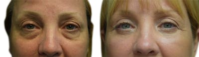 Blepharoplasty (Eyelid Surgery) Before & After Gallery - Patient 312693 - Image 1