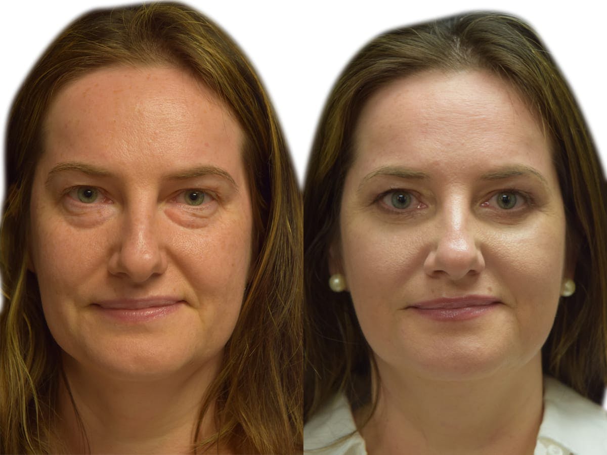 Blepharoplasty (Eyelid Surgery) Before & After Gallery - Patient 160849 - Image 2