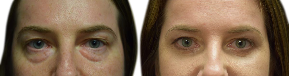 Blepharoplasty (Eyelid Surgery) Before & After Gallery - Patient 160849 - Image 1