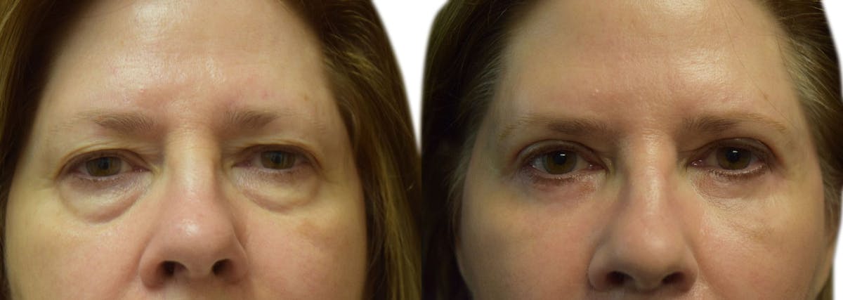 Blepharoplasty (Eyelid Surgery) Before & After Gallery - Patient 213502 - Image 1