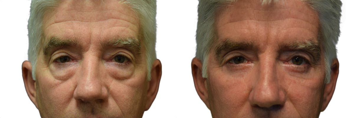 Blepharoplasty (Eyelid Surgery) Before & After Gallery - Patient 685525 - Image 1