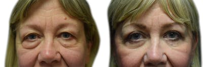 Blepharoplasty (Eyelid Surgery) Before & After Gallery - Patient 426311 - Image 1