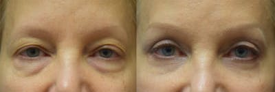 Blepharoplasty (Eyelid Surgery) Before & After Gallery - Patient 324386 - Image 1