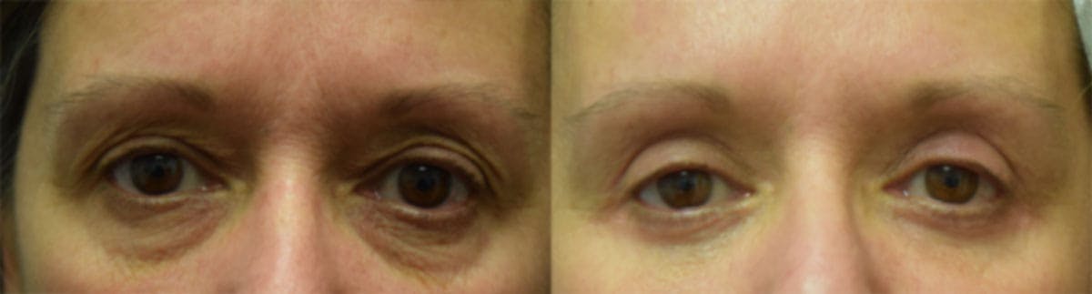 Blepharoplasty (Eyelid Surgery) Before & After Gallery - Patient 412459 - Image 1