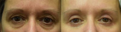 Blepharoplasty (Eyelid Surgery) Before & After Gallery - Patient 412459 - Image 1