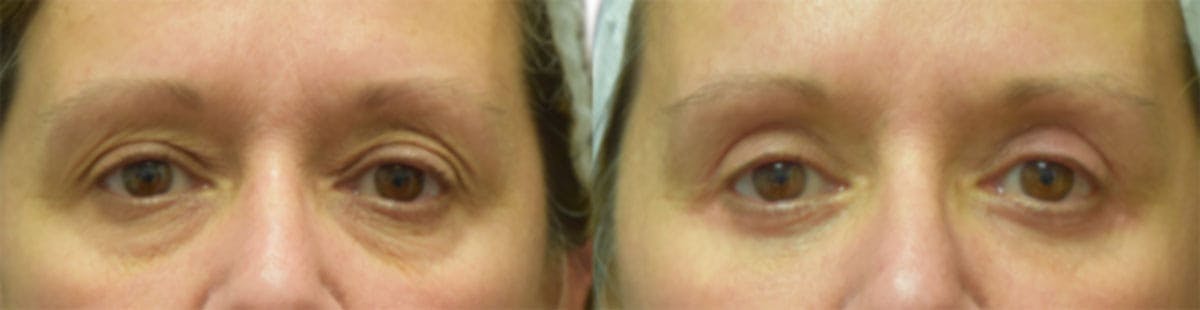 Blepharoplasty (Eyelid Surgery) Before & After Gallery - Patient 412459 - Image 2