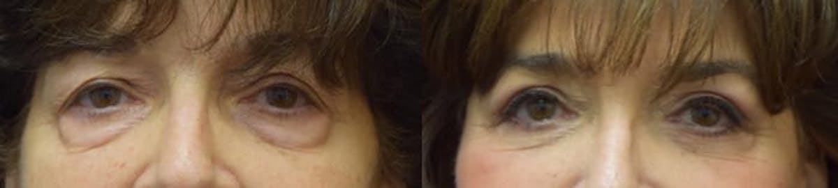 Blepharoplasty (Eyelid Surgery) Before & After Gallery - Patient 153186 - Image 1
