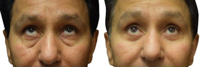 Blepharoplasty (Eyelid Surgery) Before & After Gallery - Patient 135333 - Image 1