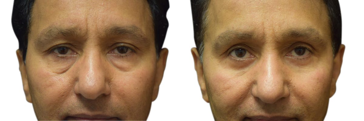 Blepharoplasty (Eyelid Surgery) Before & After Gallery - Patient 135333 - Image 2