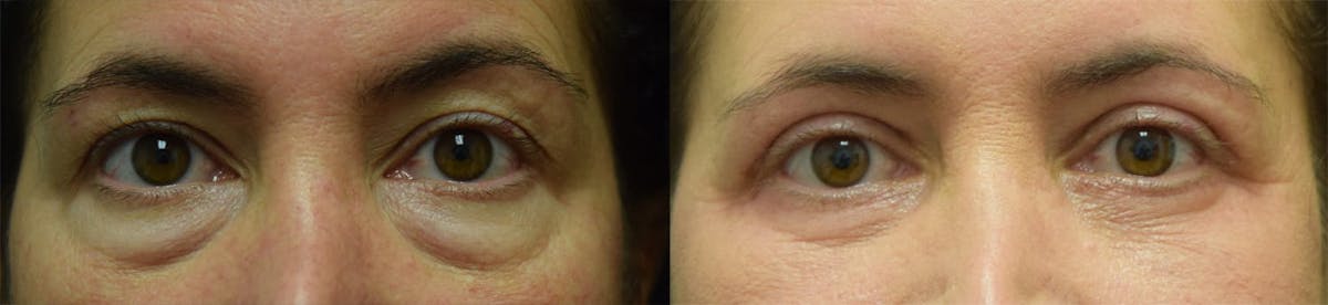 Blepharoplasty (Eyelid Surgery) Before & After Gallery - Patient 986559 - Image 1