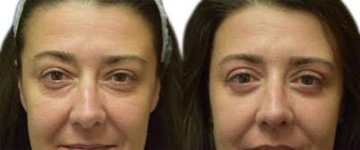 Blepharoplasty (Eyelid Surgery) Before & After Gallery - Patient 424772 - Image 1