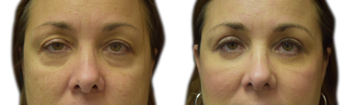Blepharoplasty (Eyelid Surgery) Before & After Gallery - Patient 134580 - Image 1