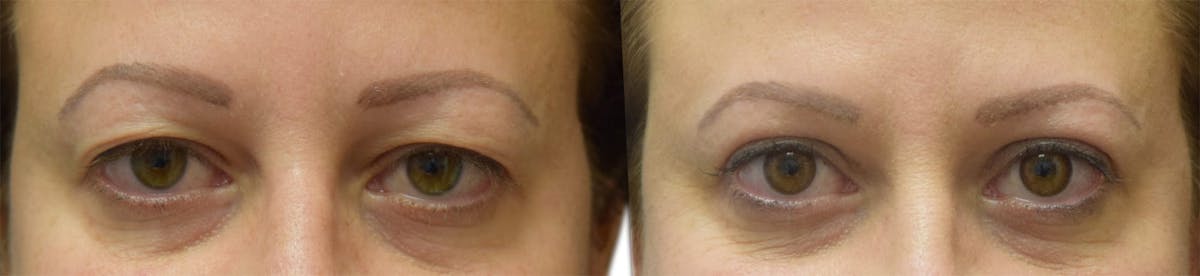 Blepharoplasty (Eyelid Surgery) Before & After Gallery - Patient 275215 - Image 1