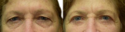Blepharoplasty (Eyelid Surgery) Before & After Gallery - Patient 368469 - Image 1