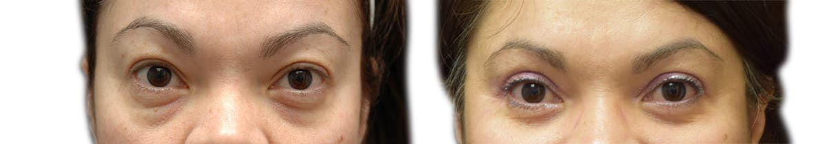 Blepharoplasty (Eyelid Surgery) Before & After Gallery - Patient 243371 - Image 1