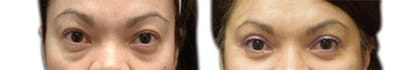 Blepharoplasty (Eyelid Surgery) Before & After Gallery - Patient 243371 - Image 1