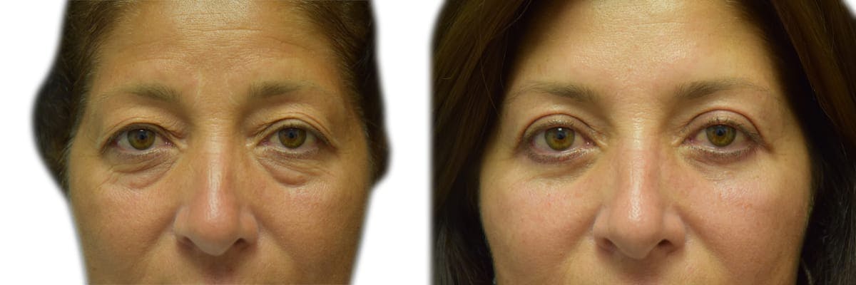 Blepharoplasty (Eyelid Surgery) Before & After Gallery - Patient 268863 - Image 1