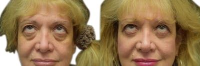 Blepharoplasty (Eyelid Surgery) Before & After Gallery - Patient 173967 - Image 1