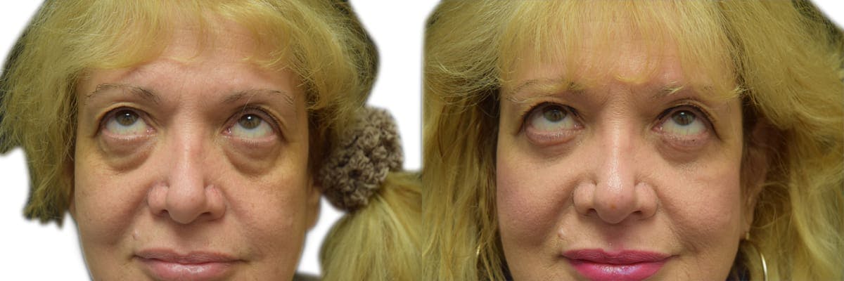 Blepharoplasty (Eyelid Surgery) Before & After Gallery - Patient 173967 - Image 1