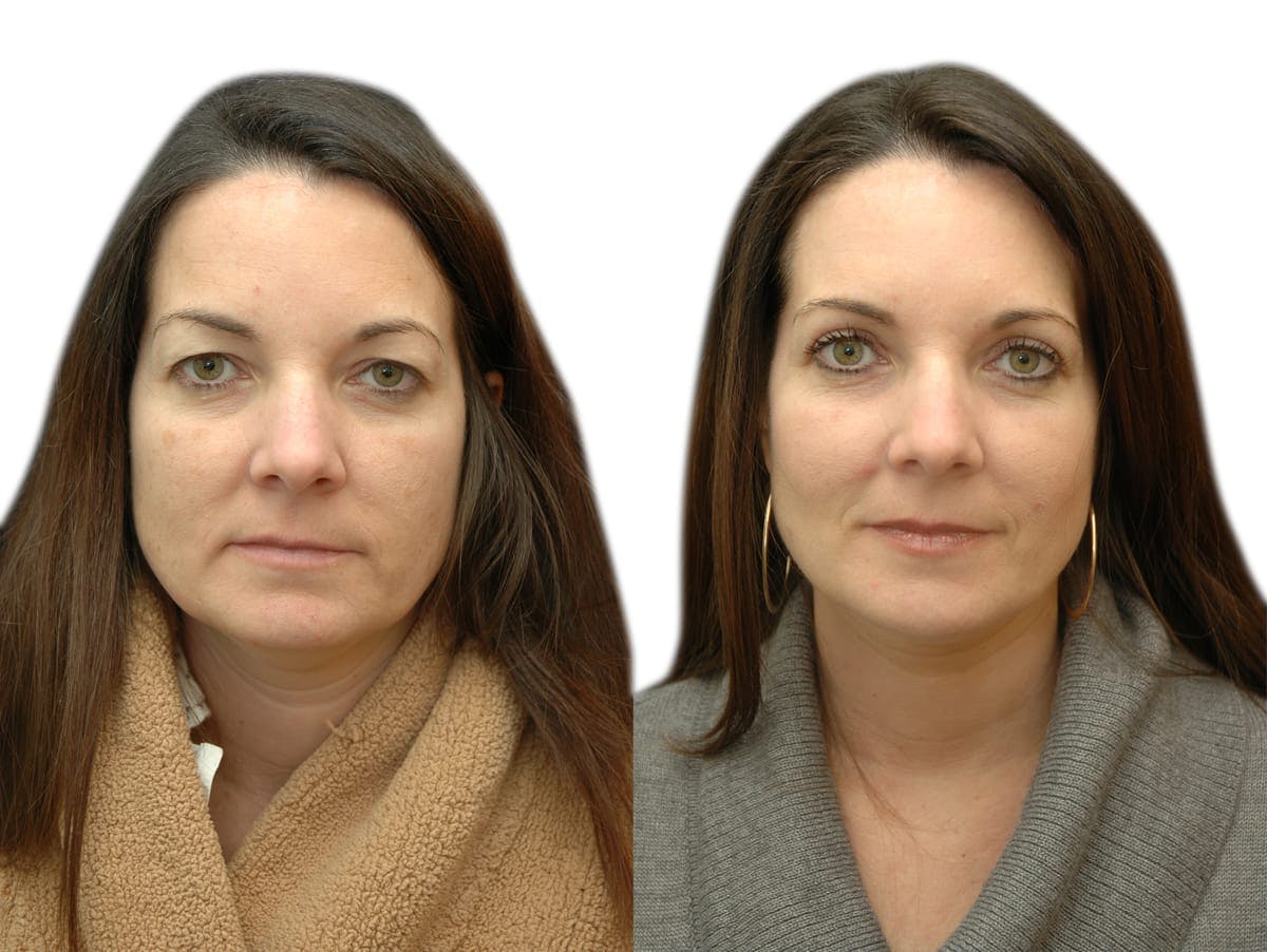 Blepharoplasty (Eyelid Surgery) Before & After Gallery - Patient 116988 - Image 2