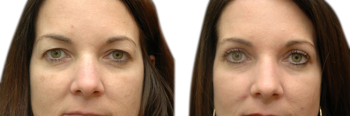 Blepharoplasty (Eyelid Surgery) Before & After Gallery - Patient 116988 - Image 1