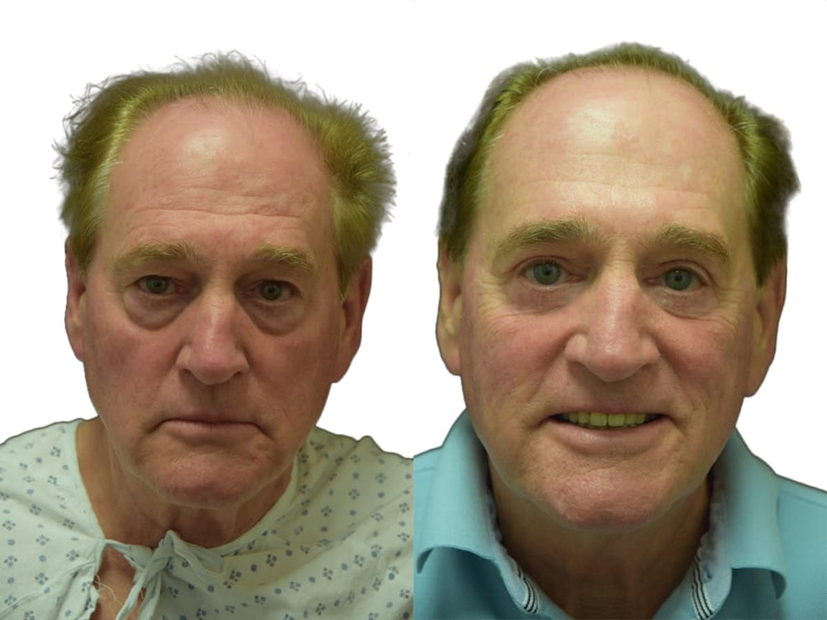 Blepharoplasty (Eyelid Surgery) Before & After Gallery - Patient 163908 - Image 2