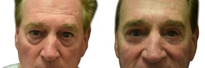 Blepharoplasty (Eyelid Surgery) Before & After Gallery - Patient 163908 - Image 1