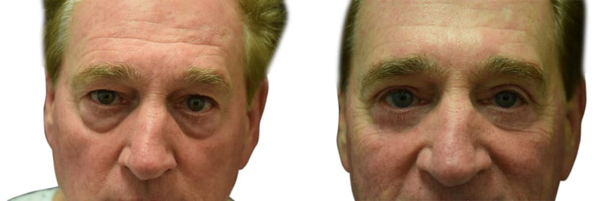 Blepharoplasty (Eyelid Surgery) Before & After Gallery - Patient 163908 - Image 1
