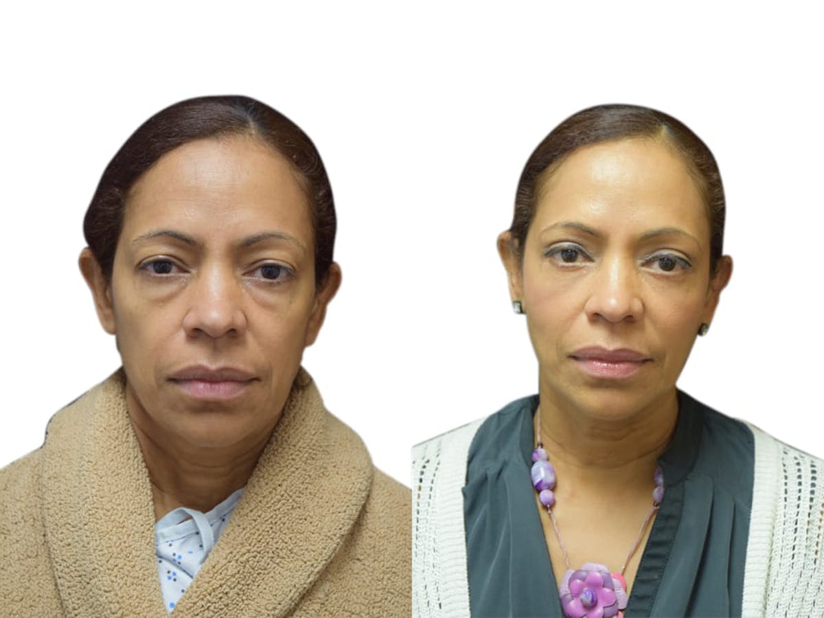 Blepharoplasty (Eyelid Surgery) Before & After Gallery - Patient 344401 - Image 2