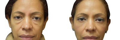 Blepharoplasty (Eyelid Surgery) Before & After Gallery - Patient 344401 - Image 1