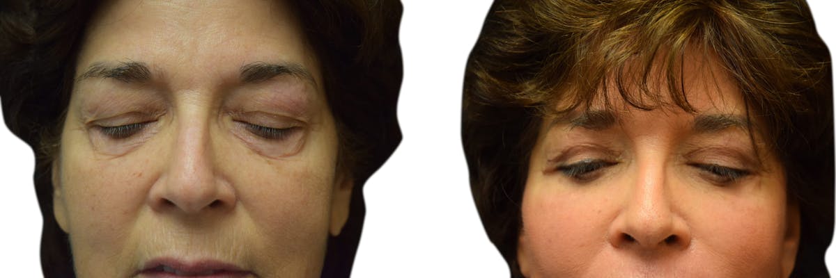 Blepharoplasty (Eyelid Surgery) Before & After Gallery - Patient 216462 - Image 2