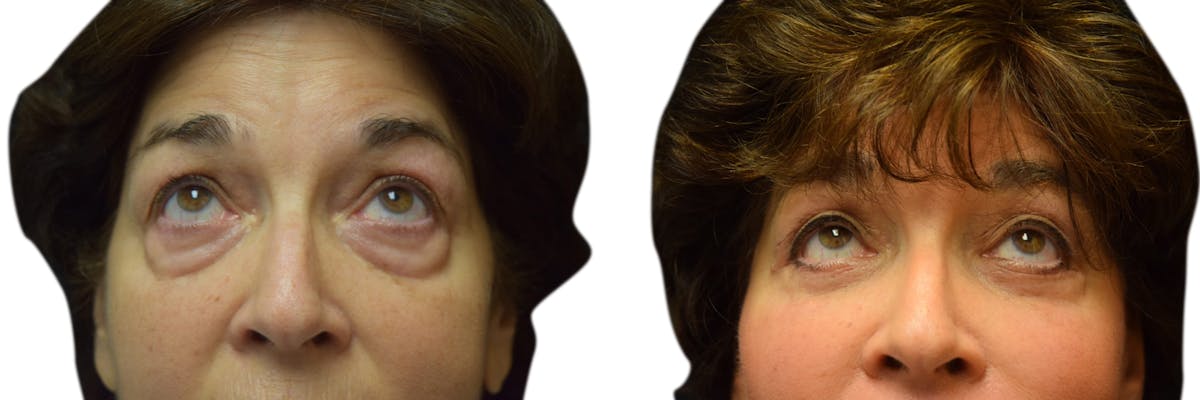 Blepharoplasty (Eyelid Surgery) Before & After Gallery - Patient 216462 - Image 1