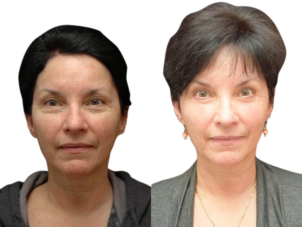 Blepharoplasty (Eyelid Surgery) Before & After Gallery - Patient 114158 - Image 2