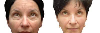 Blepharoplasty (Eyelid Surgery) Before & After Gallery - Patient 114158 - Image 1