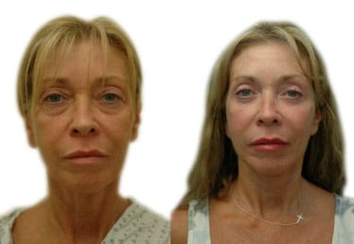 Blepharoplasty (Eyelid Surgery) Before & After Gallery - Patient 939273 - Image 2