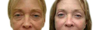 Blepharoplasty (Eyelid Surgery) Before & After Gallery - Patient 939273 - Image 1