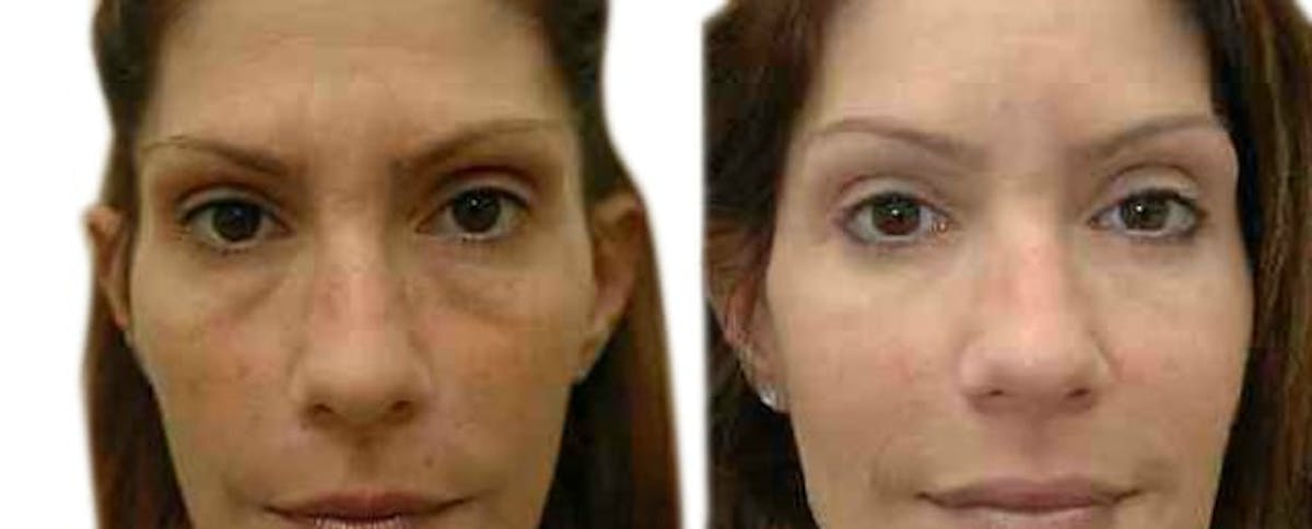 Blepharoplasty (Eyelid Surgery) Before & After Gallery - Patient 147208 - Image 1