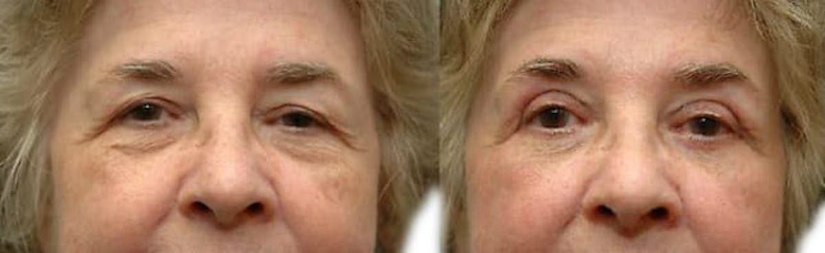 Blepharoplasty (Eyelid Surgery) Before & After Gallery - Patient 424857 - Image 1