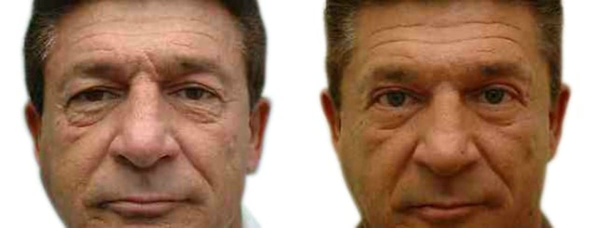 Blepharoplasty (Eyelid Surgery) Before & After Gallery - Patient 330671 - Image 1