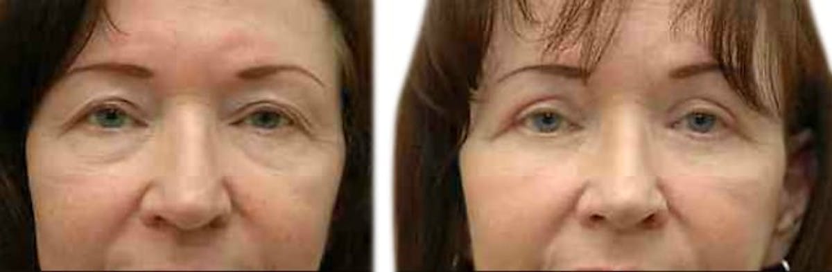 Blepharoplasty (Eyelid Surgery) Before & After Gallery - Patient 182098 - Image 1