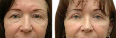 Blepharoplasty (Eyelid Surgery) Before & After Gallery - Patient 182098 - Image 1