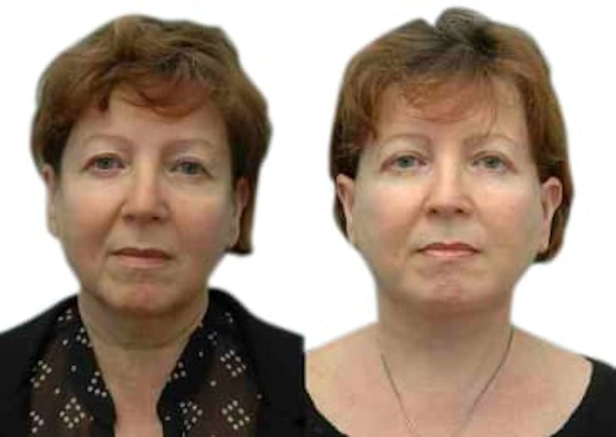 Blepharoplasty (Eyelid Surgery) Before & After Gallery - Patient 326291 - Image 1